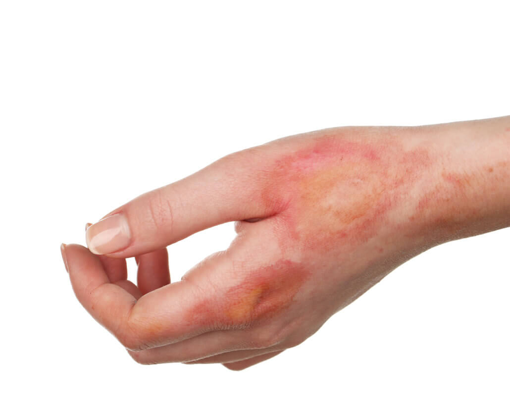 pressure cooker hand burn injury