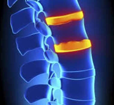 Spinal Fusion Lawsuits and Settlement Guide